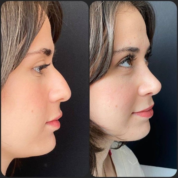What Is the Difference Between Open and Closed Rhinoplasty?